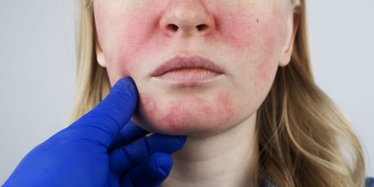 Dangers et contre-indications peeling chimique