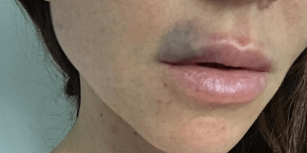 Bruising after injection with hyaluronic acid Lausanne - Ecchymosis after injection with hyaluronic acid