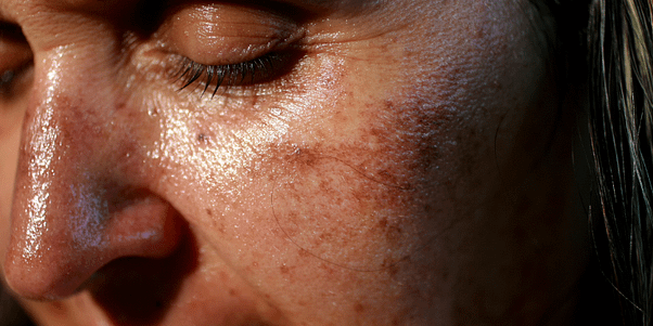 Example of hormonal pigmentation due to pregnancy