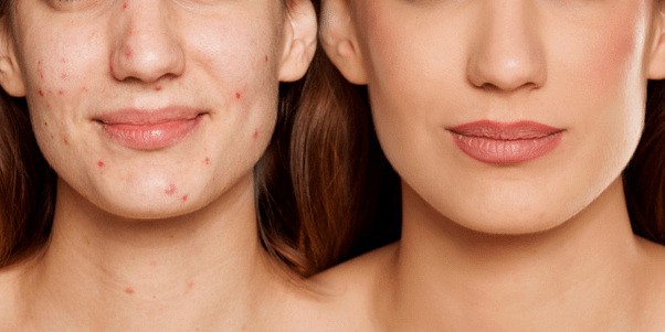 Traitement contre l'acné femme adulte Lausanne