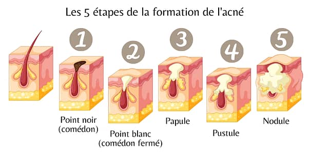 The 5 stages of acne formation - Papillon de beauté Lausanne