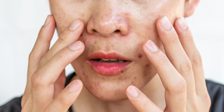 Exemples de cicatrices dûes à l'acné Lausanne